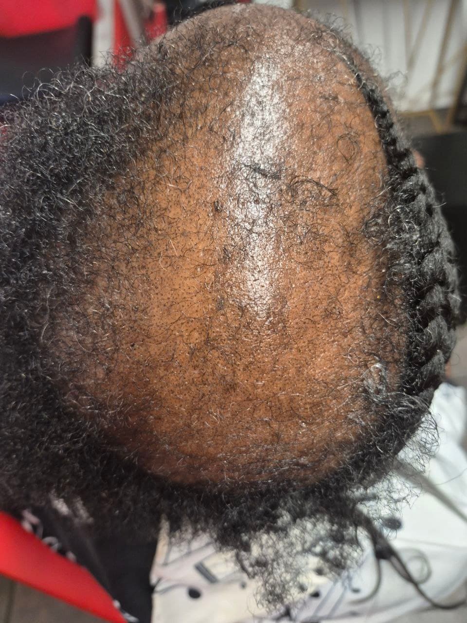 Alopecia Coverup
